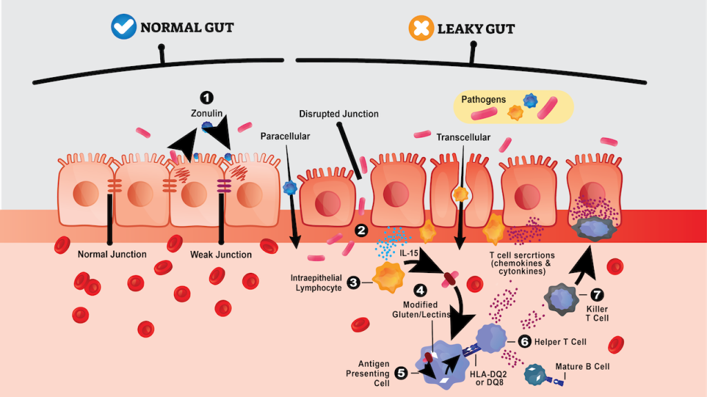 Normal Gut and Leaky Gut Banner