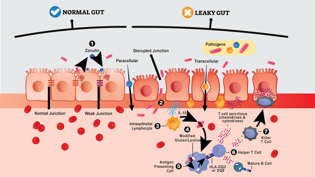 Gundry Health Normal Gut and Leaky Gut Banner