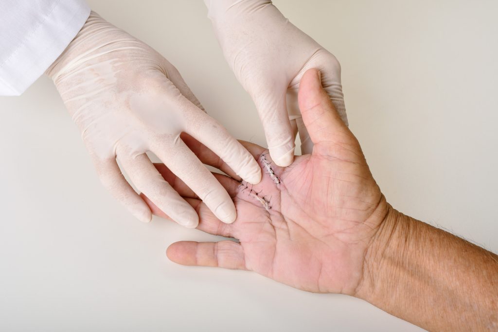 Hand surgery treatment