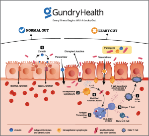 Leaky Gut Explained - Gundry Health - A holistic approach to clinical